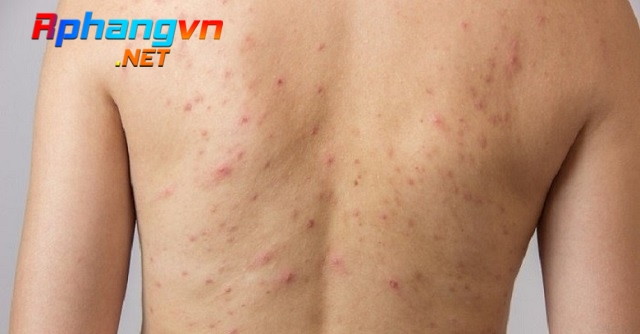 cach-tri-mun-lung-1.jpg